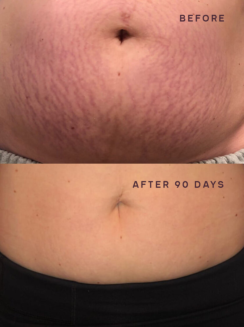 SILICONEFUSION™ Large Body Patch
