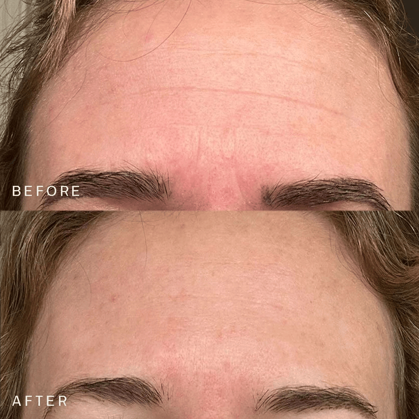 Forehead Occlusion Patch™